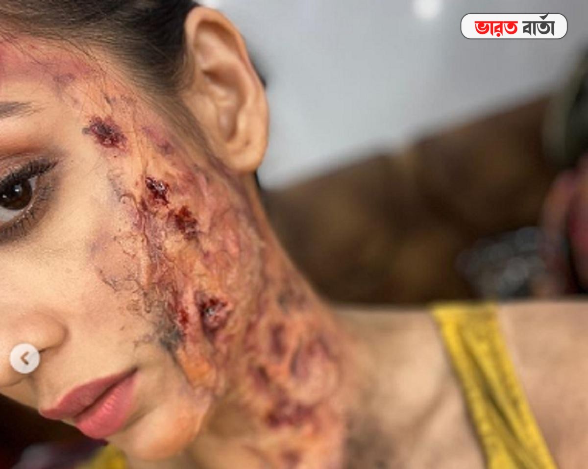 ছেঁড়া জামা, সারা মুখে পোড়া দগদগে ঘা মিমির, ভয়ানক ছবি ভাইরাল ছেঁড়া জামা, সারা মুখে পোড়া দগদগে ঘা মিমির, ভয়ানক ছবি ভাইরাল