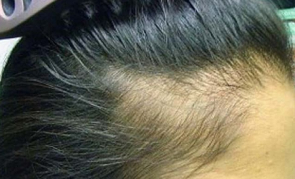 Hair Care Tips: চুল পড়ে মাথা ফাঁকা হয়ে যাচ্ছে? ব্যাবহার করুন এই সহজ ঘরোয়া পদ্ধতি, পাবেন হাতে নাতে ফল