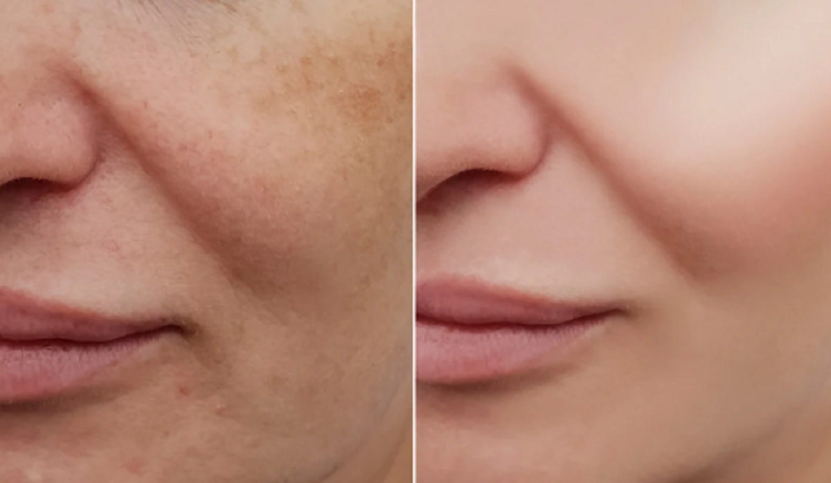 Skin Care Tips: ১ সপ্তাহে মুখের দাগ তুলতে ব্যবহার করুন এই ফেসপ্যাক, নিমিষে ঘরেই তৈরি করা যাবে Skin Care Tips: ১ সপ্তাহে মুখের দাগ তুলতে ব্যবহার করুন এই ফেসপ্যাক, নিমিষে ঘরেই তৈরি করা যাবে